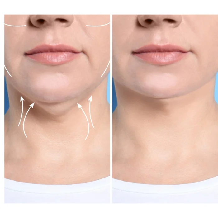 Jowls and Sagging Skin Reduced after applying serum